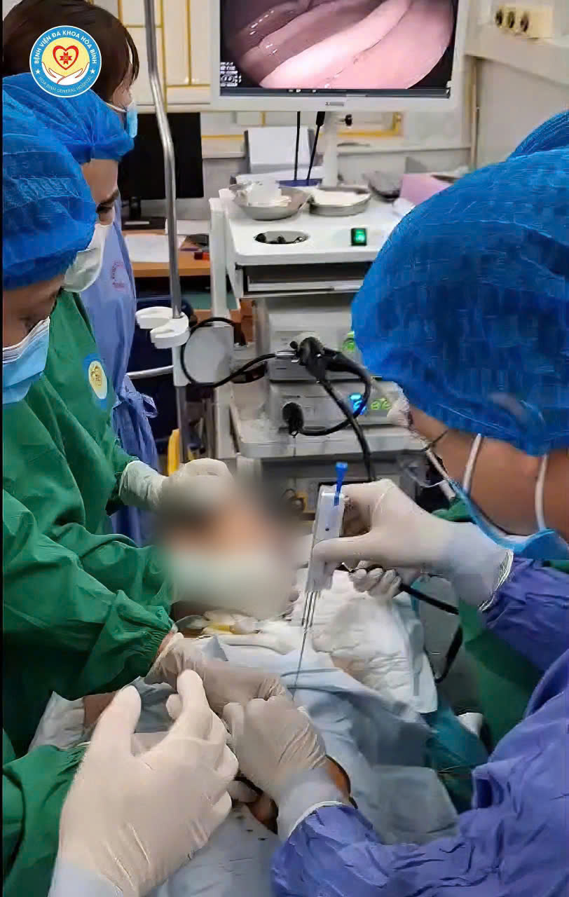   Bệnh viện Đa khoa Hoà Bình triển khai thành công kỹ thuật mở thông dạ dày qua nội soi (PEG)