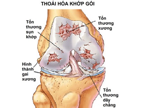  Thoái hóa khớp gối - Hiểu đúng để phòng ngừa và điều trị hiệu quả